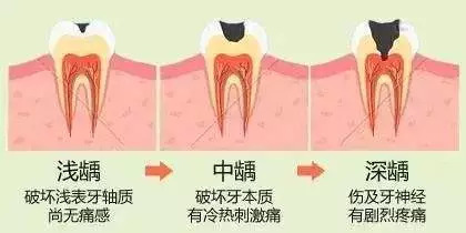 小粤粤提醒小明不要吃多了糖,还要多刷牙,你的牙齿已经处于浅龋状态