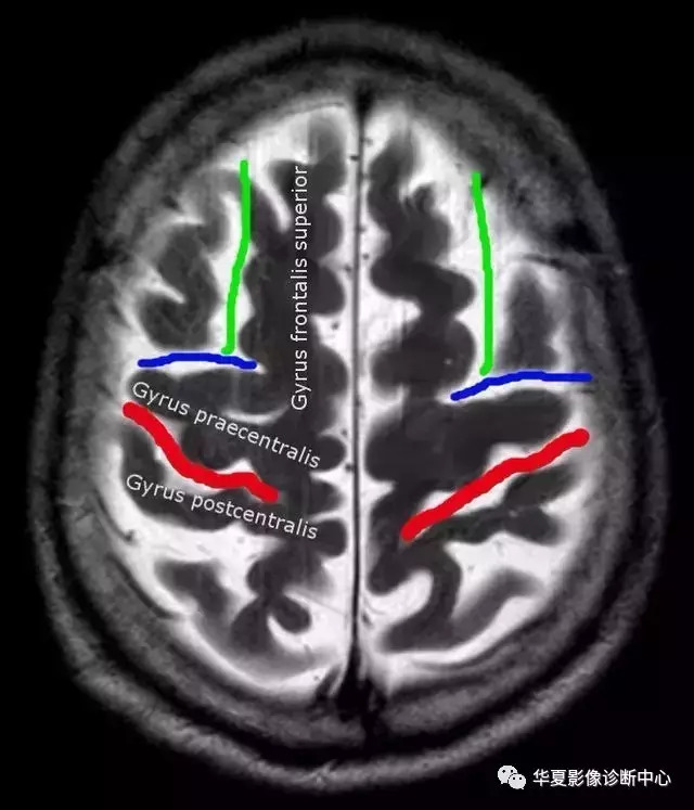 5个征象让您认清中央沟准确区分额顶叶