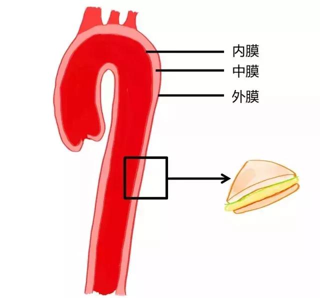 主动脉夹层是咋回事儿?