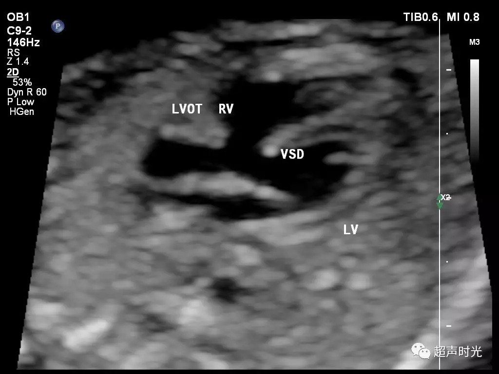 超声典型病例：胎儿法洛四联症合并右位主动脉弓_肺动脉