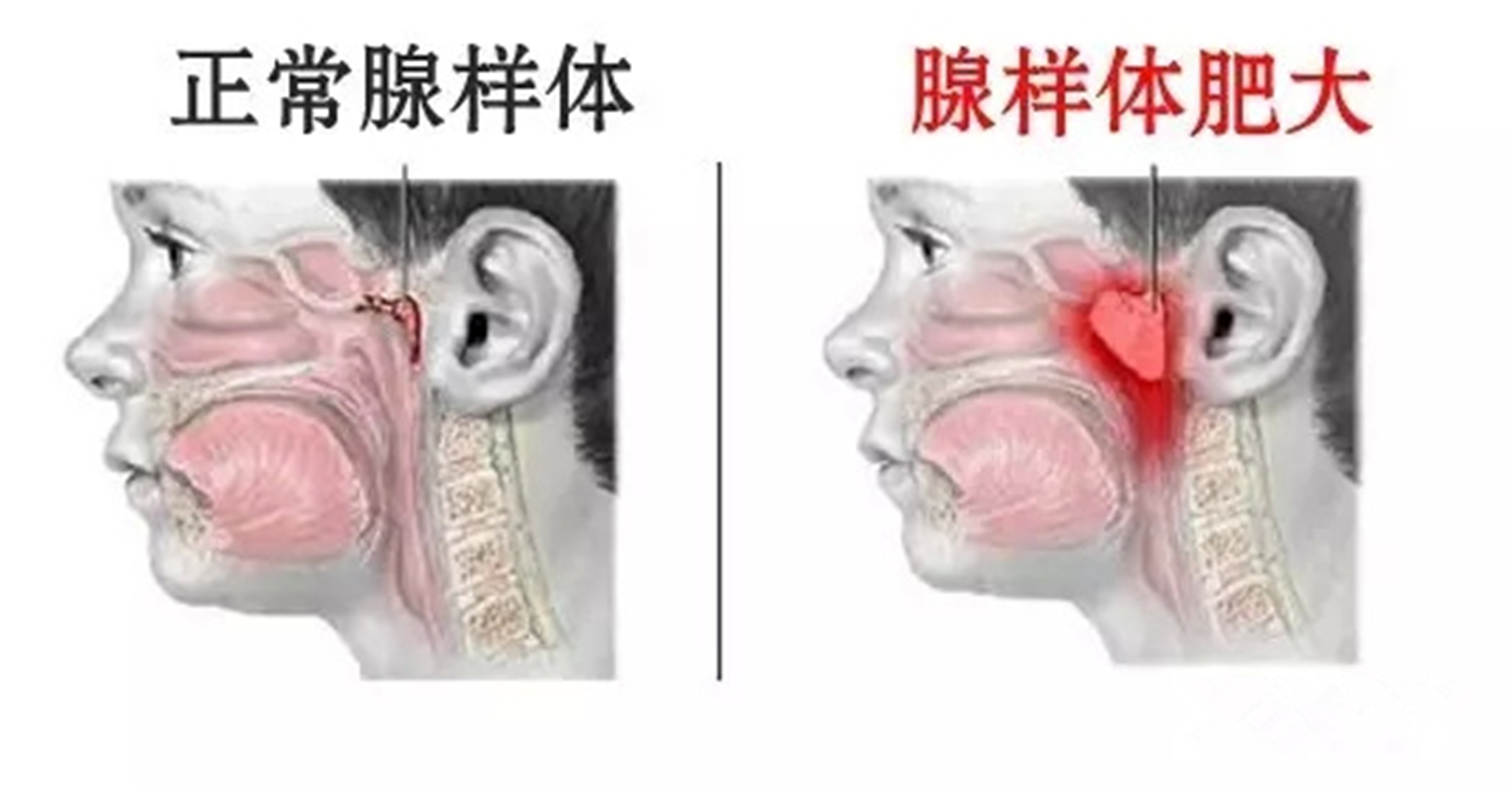 正常人口腔很难长尖锐_口腔内尖锐疣长什么样(2)