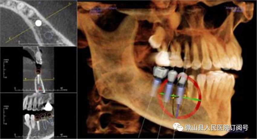 7.口腔ct 3d重建显示下颌神经管
