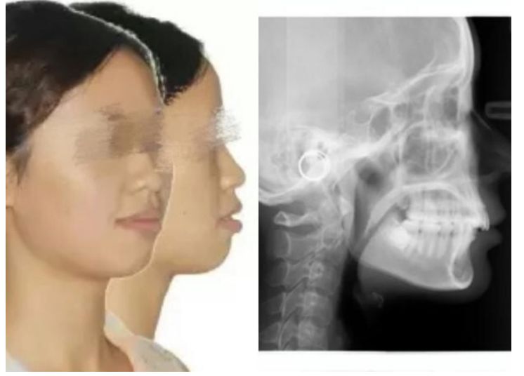 骨性Ⅱ类示例,常见凸面型,x光片可见下颌骨明显后缩