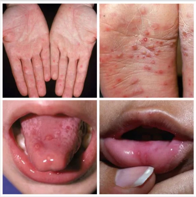 手足口病引起的疹子是一种透明的水疱,主要集中在手,脚,口腔和肛门