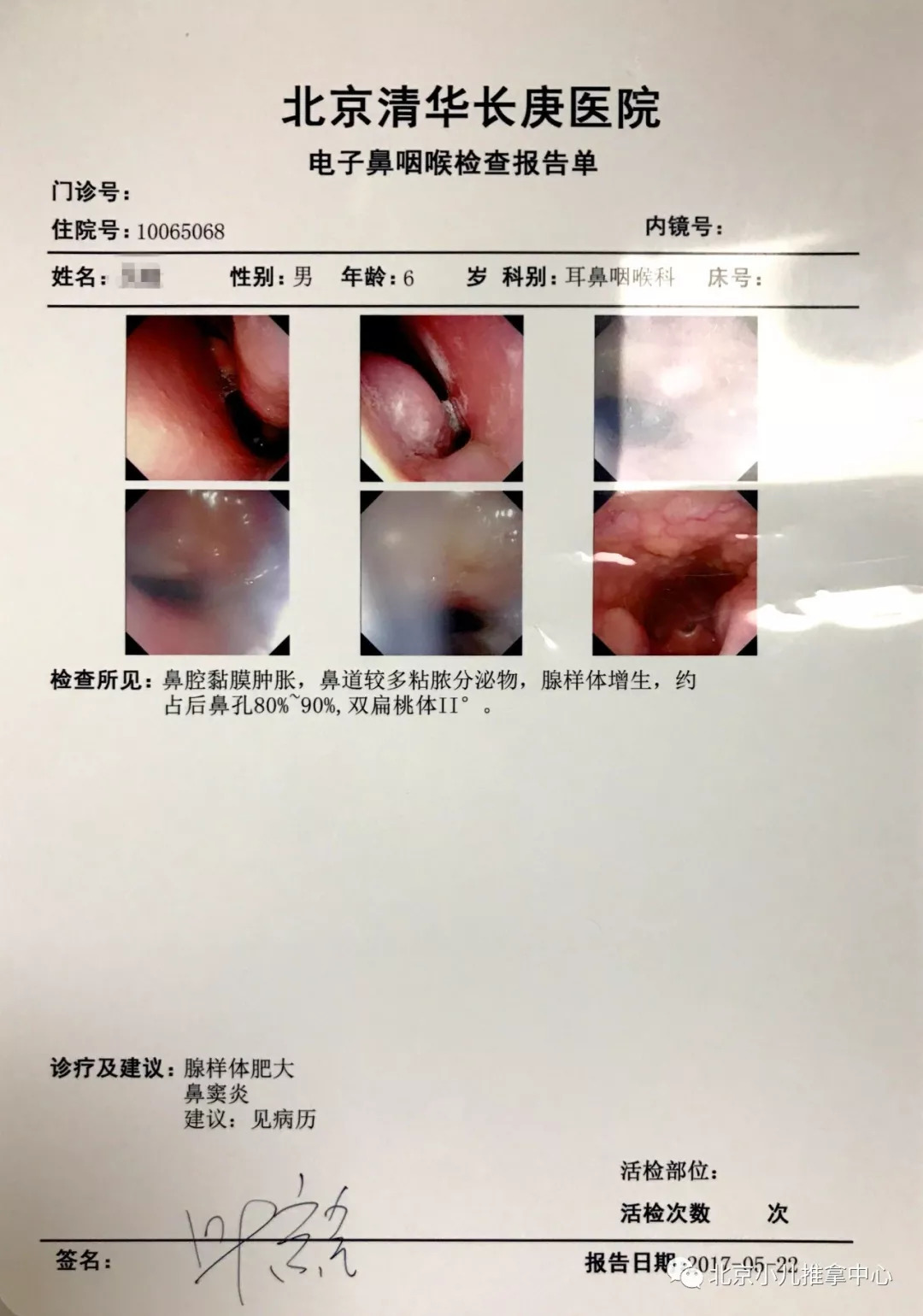 咱家宝宝腺样体肥大