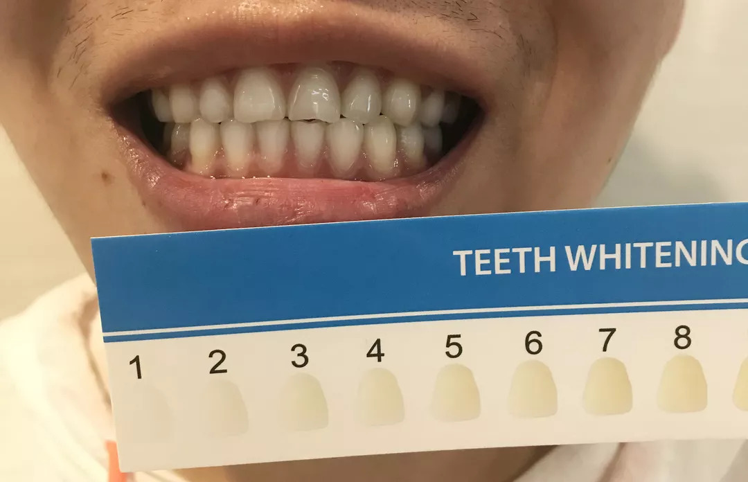 使用白牙素牙膏刷牙,为期一周后对比,并用 牙齿冷光美白色阶卡记录下