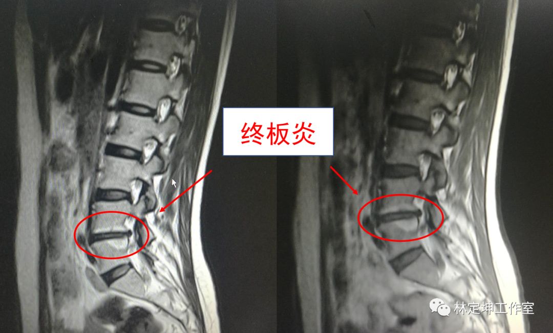 谈骨论筋腰椎间盘突出合并终板炎引发腰痛腿痛等症状一定要做手术