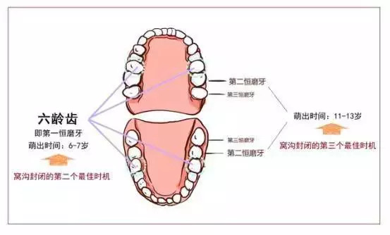 预防孩子龋齿最好的方法叫窝沟封闭