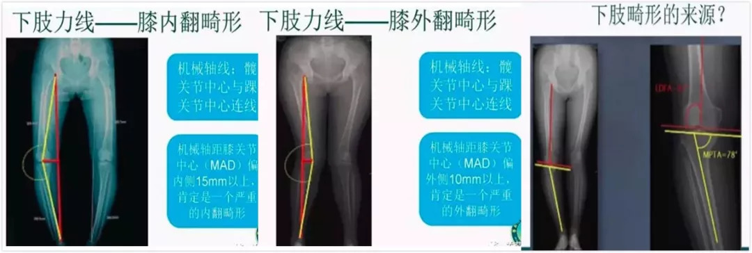 其次,在x线片上进行准确下肢力线分析,判断膝关节内翻或外翻畸形,并