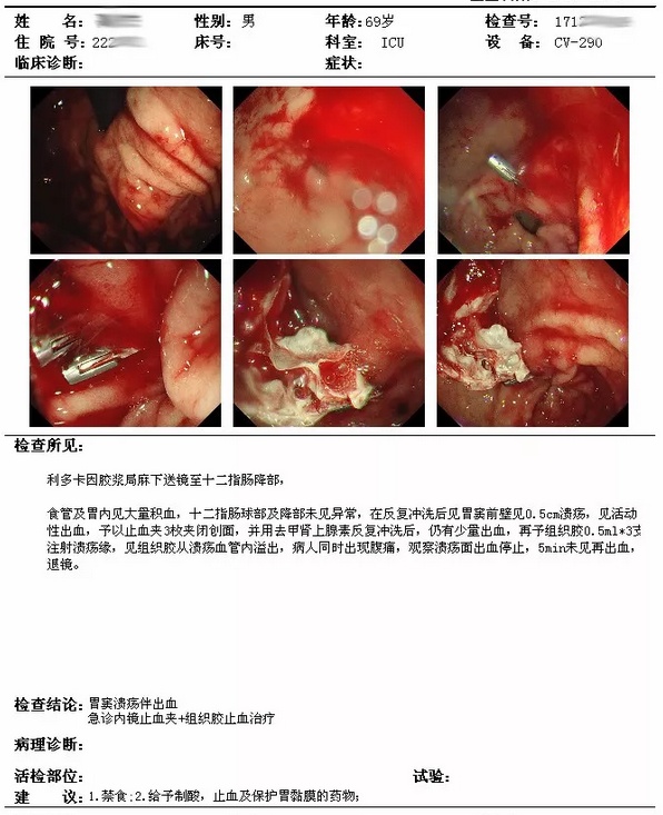 胃窦溃疡伴出血与阿司匹林有关?阿司匹林是"魔鬼"还是