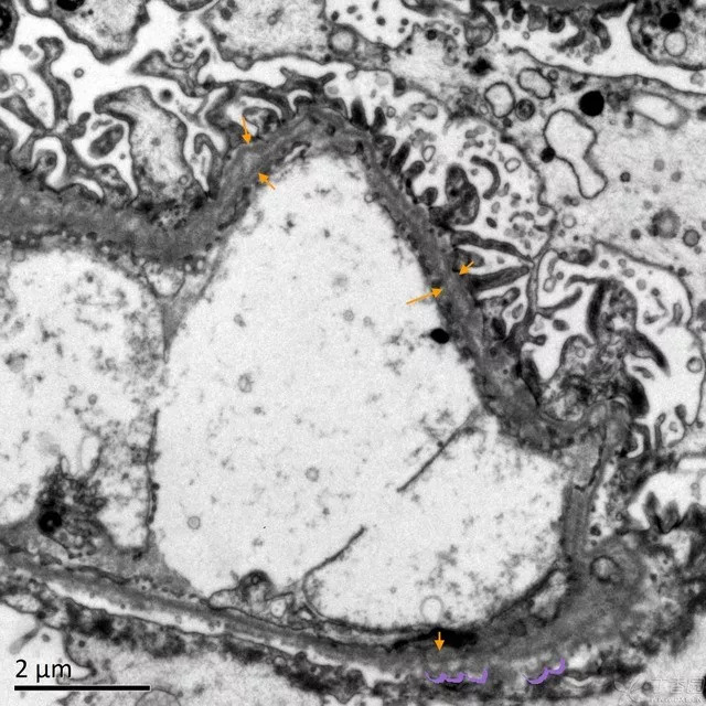 电镜也疯狂 | alport"s综合征