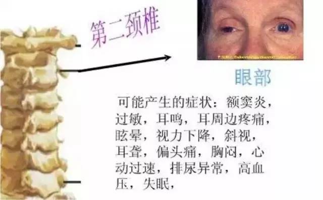 脊柱引起的108种疾病大全,建议收藏!