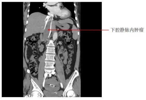 增强ct显示肿瘤沿着下腔静脉一直生长至右心房