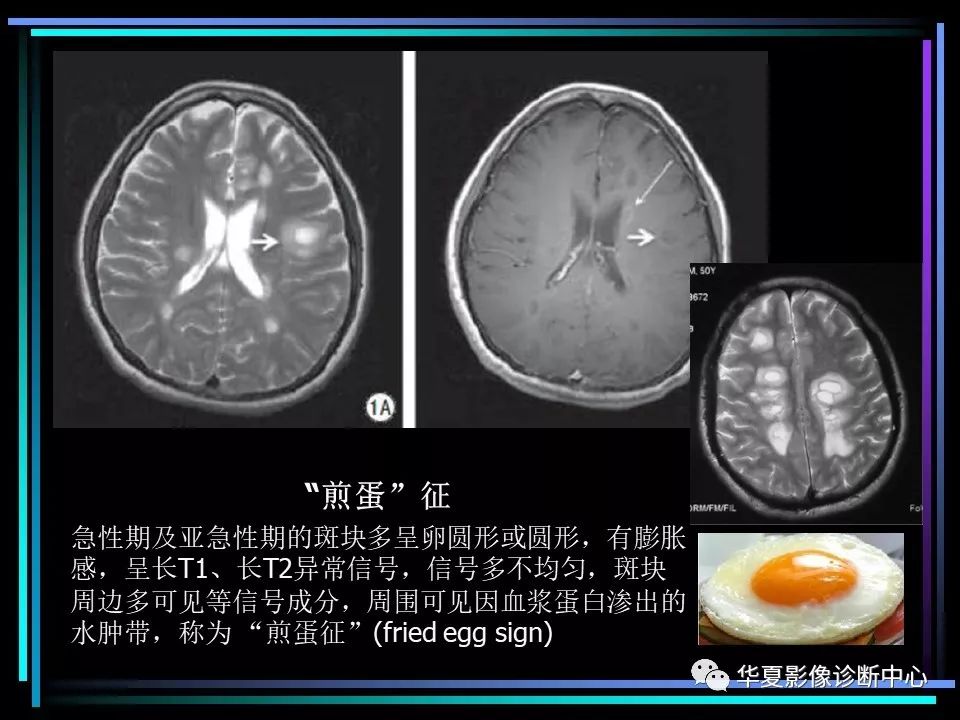 多发性硬化影像学诊断(简版)