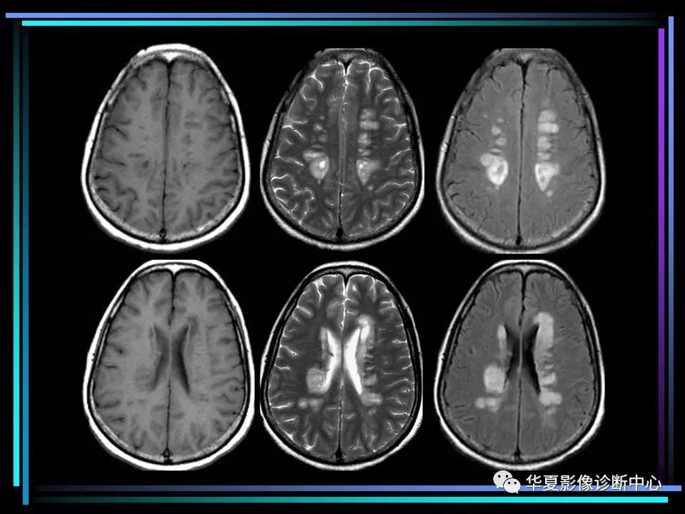 多发性硬化影像学诊断(简版)