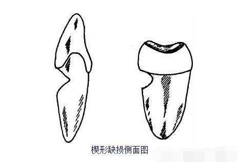 为何会出现楔状缺损?