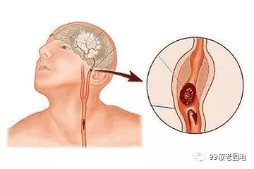 有血栓的人口比例_腿上有血栓真人图片