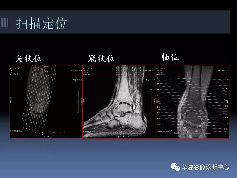 踝关节mri解剖及常见病变