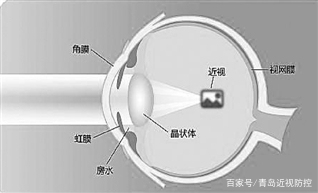 小孩眼睛屈光怎么办