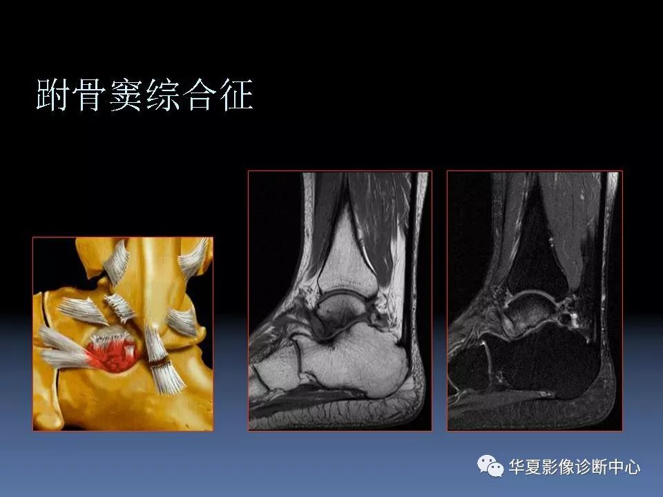 踝关节mri解剖及常见病变