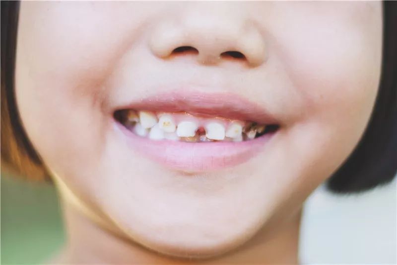 若乳牙期口腔内龋菌含量高,容易发生传染,导致恒牙患龋齿的风险增加.