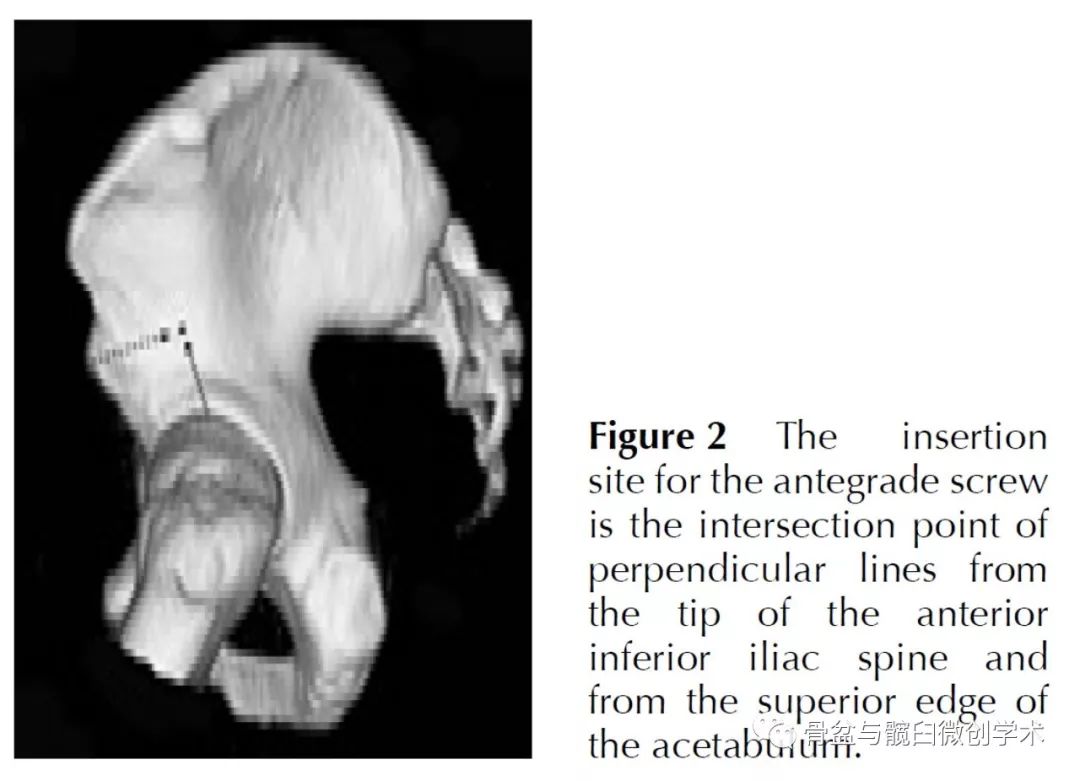 改良经皮逆行耻骨上支或髋臼前柱髓内螺钉置入技术及其应用示例