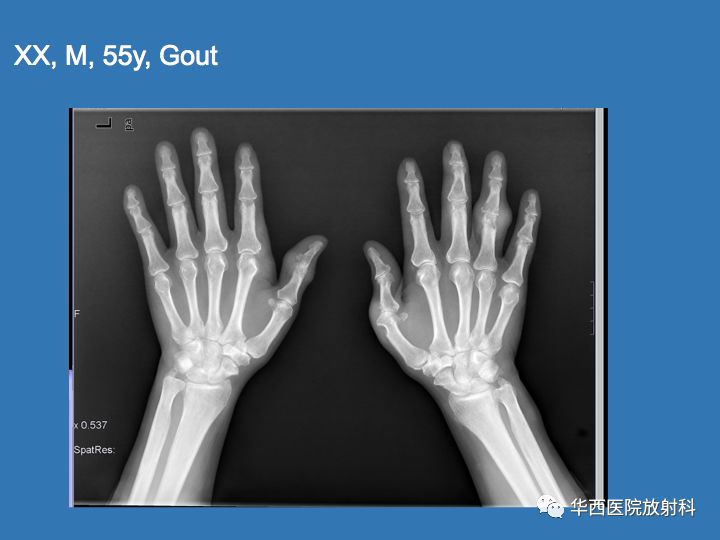 华西放射科病例汇报学习系列之二手关节炎