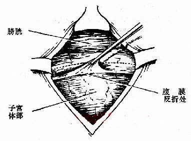 切开子宫膀胱反折腹膜2自脐下4～5cm处起,切至耻骨联合上缘,长约10