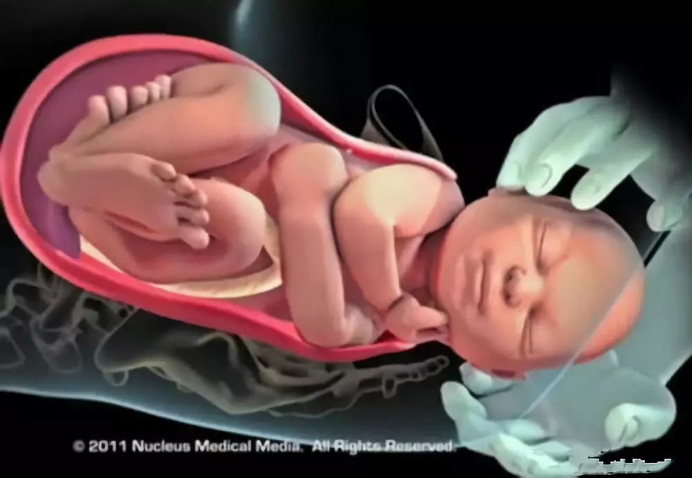 二,分娩第2个阶段:胎儿娩出期