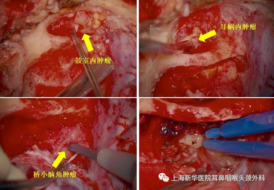 经耳囊径路听神经瘤切除