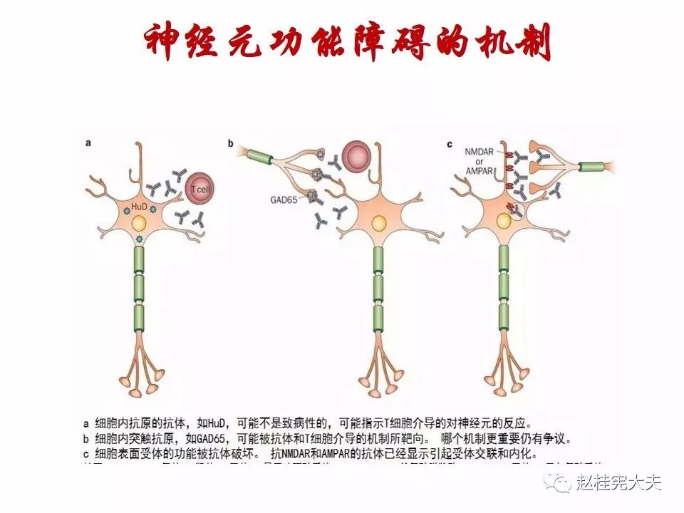 自身免疫性脑炎(ae)泛指一类由自身免疫机制介导的脑炎.