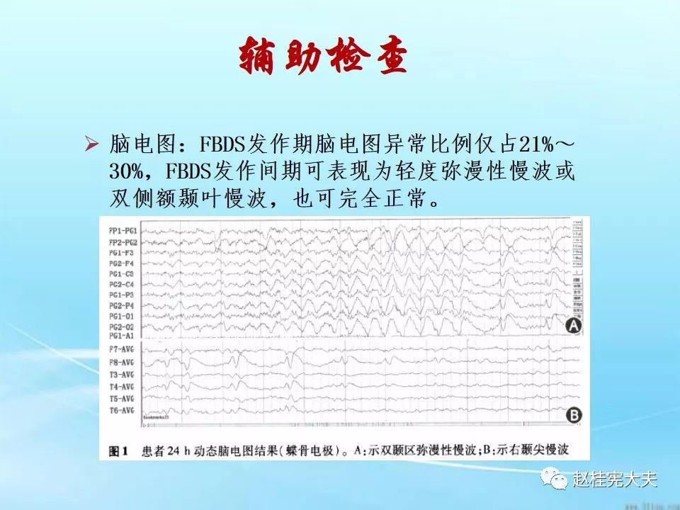 详解抗lgi1抗体相关脑炎1例及自免脑相关文献复习