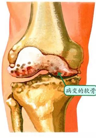 骨科二病区主治医师高沛说说膝关节骨性关节炎的那些事