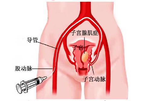 肿瘤发热病人口服奈普生_恶性肿瘤图片(2)