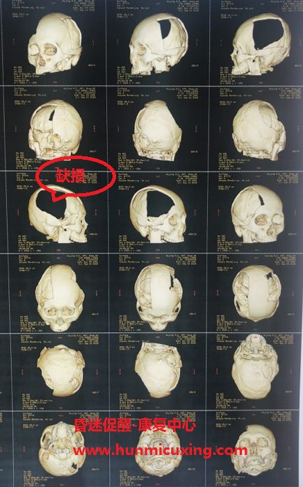 来到我们昏迷促醒中心后我们给病人检查的头颅ct三维重建,为修补