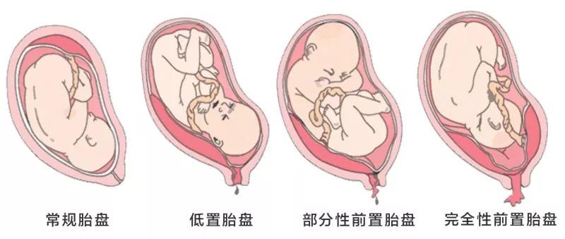 胎盘位置 一般胎盘的 正常位置是附着在子宫体部的前壁,后壁或者侧壁