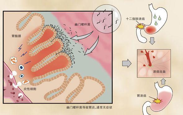 5,幽门螺杆菌感染