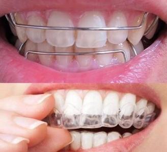 医生有你:牙齿矫正后反弹的原因?