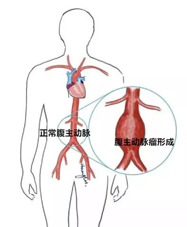 从而避免了瘤体血栓脱落,堵塞导致所血管破裂,即腹主动脉瘤体破裂大