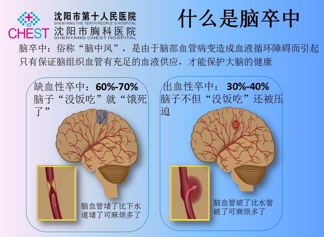 1.什么是脑卒中?