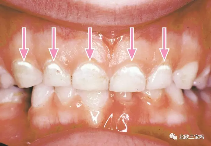 吃饭喝奶不刷牙,宝宝满嘴虫子牙(白色牙也可能是虫牙哦)