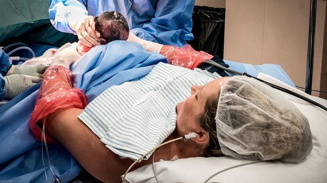 为第一时间抱才出生女儿,女子破腹产手术中自己用手将女儿拉出来