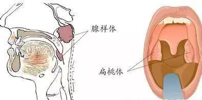 小孩嗓子化脓了怎么办