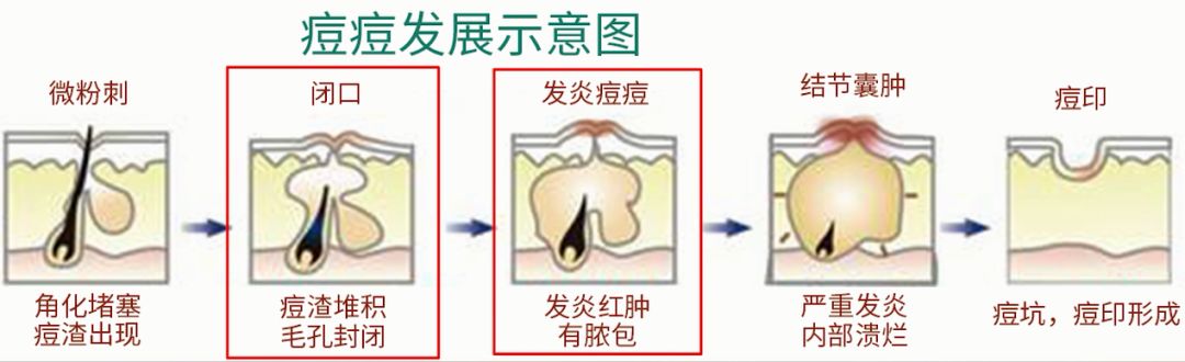 节目她现场示范挤脓包痘的正确姿势竟然引起强烈舒适感