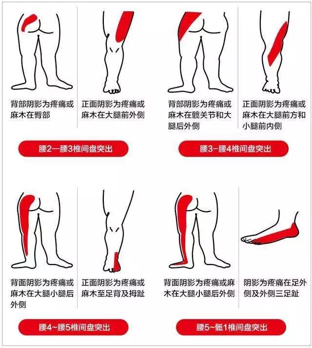 "不同地方腰椎突出,疼痛的地方不一样!