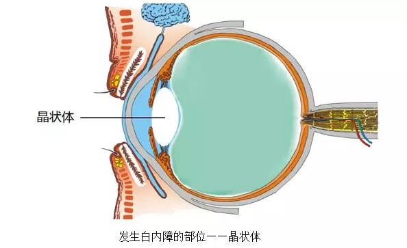 老年性白内障与硒的关系