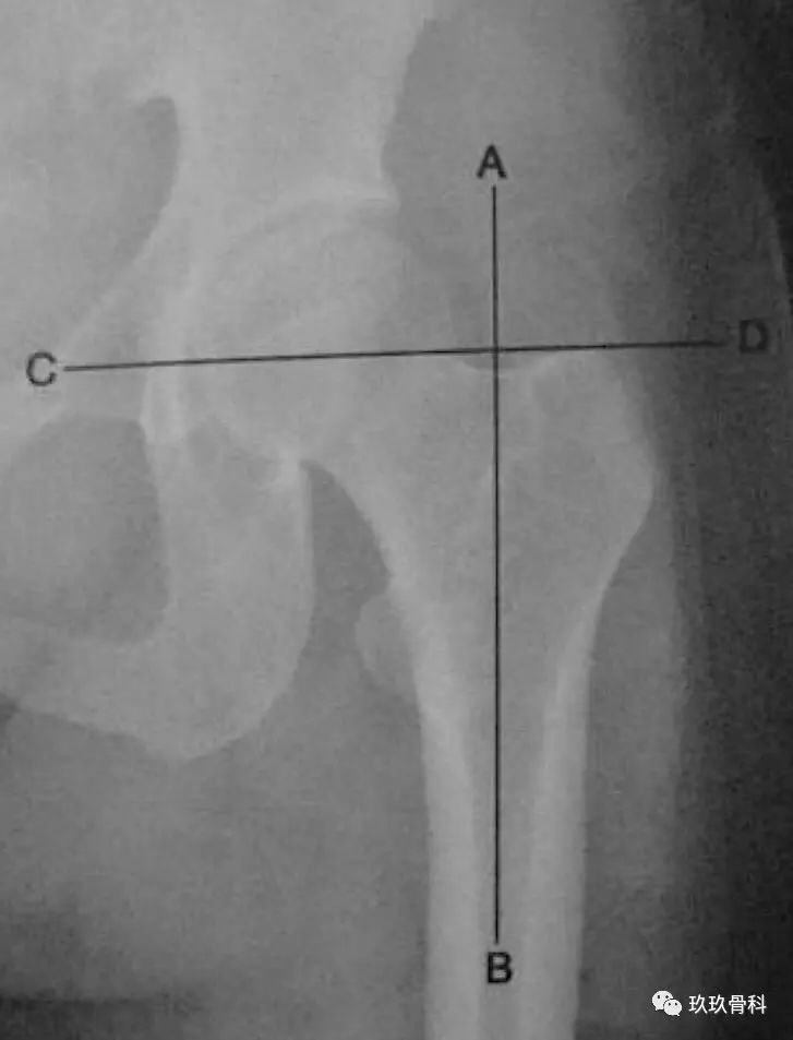 一篇全解丨髋关节x线解剖 摄影技术 测量方法_髋臼