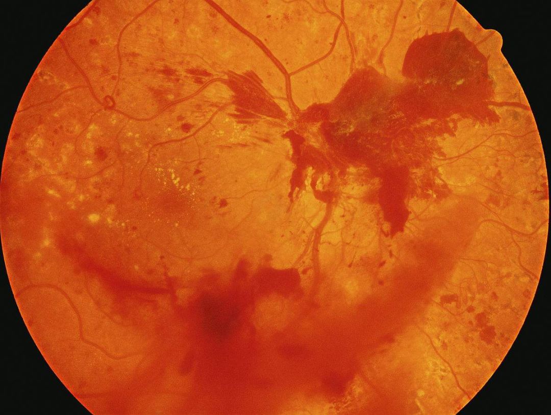 与外伤相关的视网膜病变——4、光损伤性视网膜病变 - 知乎