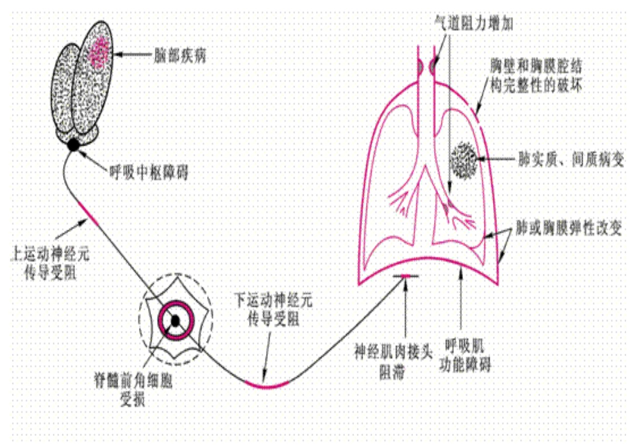 61 神经系统疾病.61 呼吸中枢;呼吸道以外61 胸廓胸膜疾病.