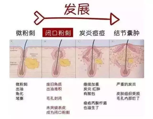 但闭口性粉刺它的毛孔是闭合的,里面的油脂并没有被氧化,可能会看到一